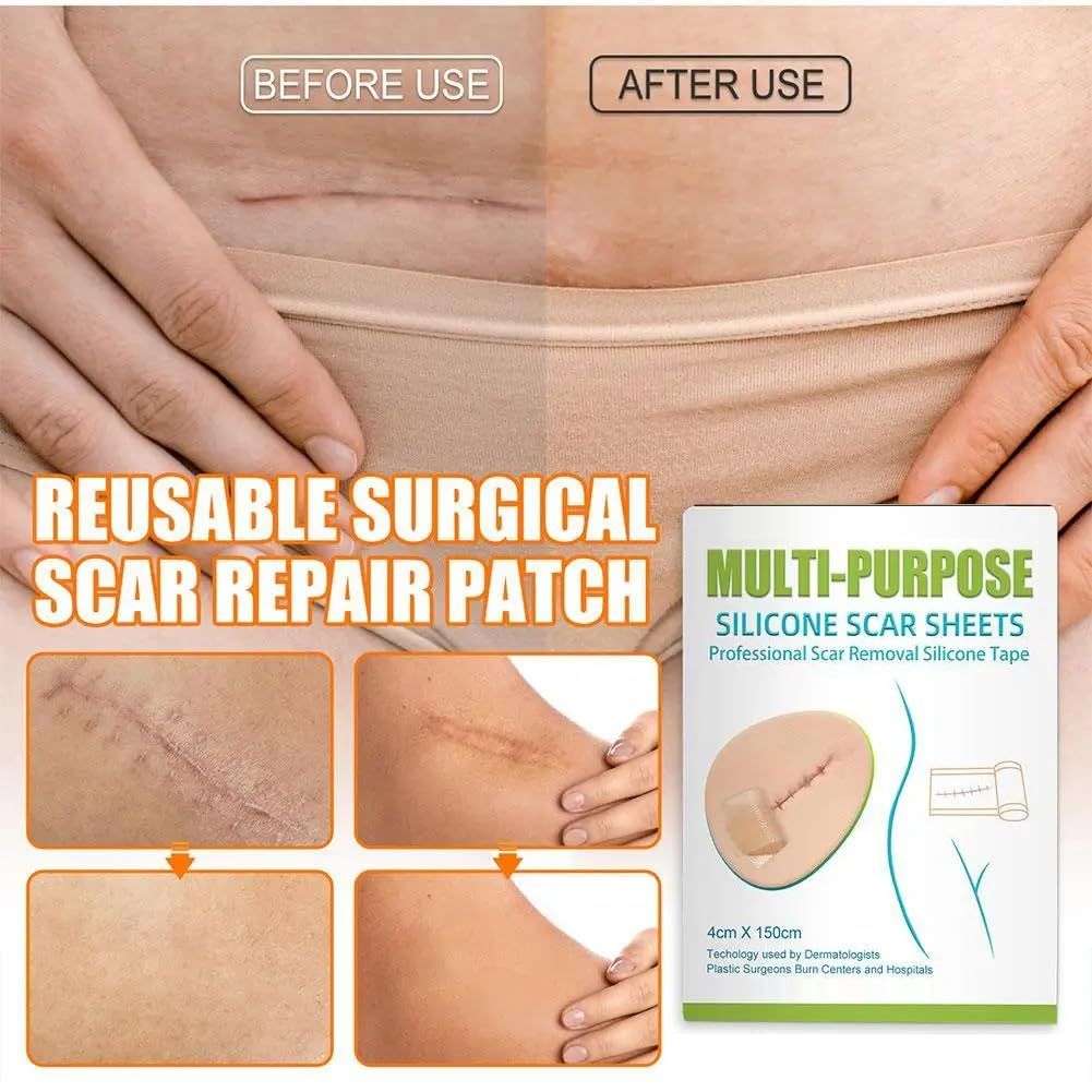 Silicone Scar Remover Tape for Acne & Wrinkles